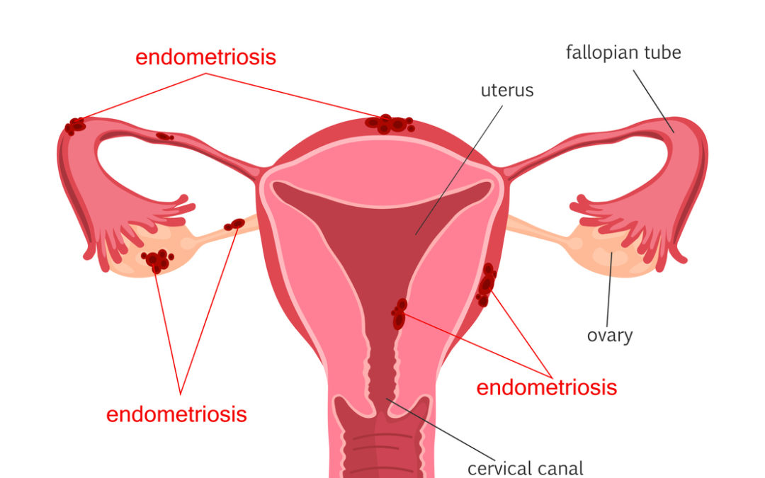 Endometriosis and Brain Fog - Seckin Endometriosis Center